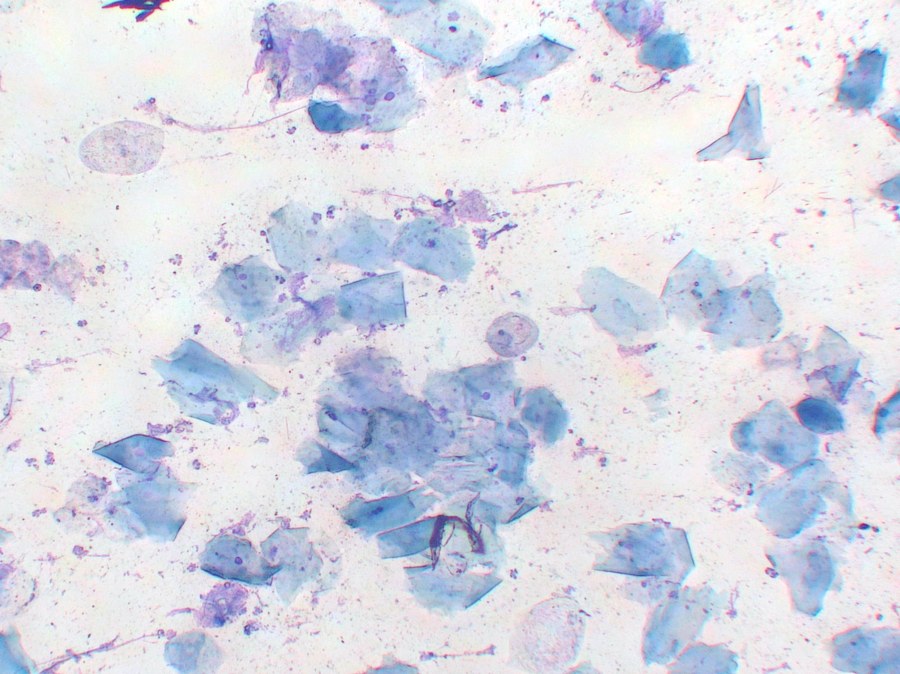 角化が進みつつある膣スメア。角ばった細胞が増え、核をもつ細胞と混在している。